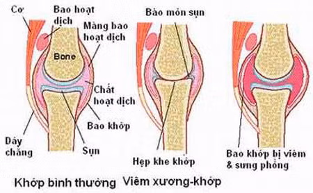 Lưu ý khi dùng thuốc trị viêm khớp dạng thấp ảnh 1