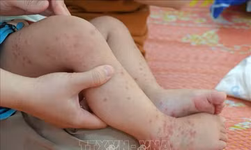 Tăng cường phòng dịch, hạn chế bệnh chuyển nặng