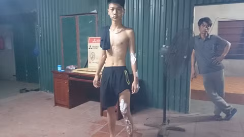 Hà Nội: Xe chở chất lỏng nghi axit làm bỏng hàng chục người ảnh 1