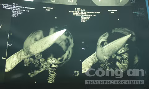 Bé trai 11 ngày tuổi bị dao đâm xuyên sọ não ảnh 1
