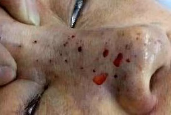 Những ca tai biến kinh hoàng vì làm đẹp ảnh 2