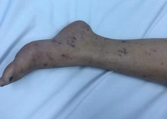Nữ sinh 15 tuổi bị viêm não mô cầu, phải điều trị cách ly đặc biệt ảnh 1