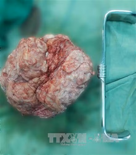 Bóc tách thành công khối u xơ nặng 4 kg cho nữ bệnh nhân ảnh 2