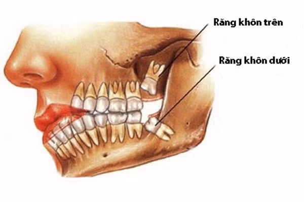 Nhổ răng khôn có thể gặp những nguy hiểm gì? ảnh 1