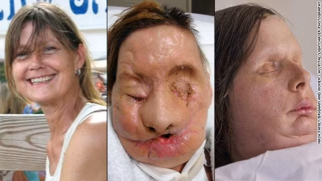 Bệnh nhân ghép mặt tìm lại niềm tin sau phẫu thuật ảnh 5