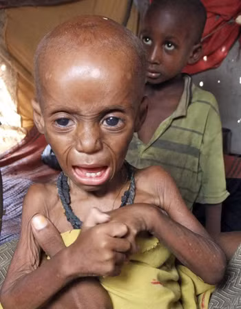 Nạn đói khủng khiếp ở Somalia ảnh 13