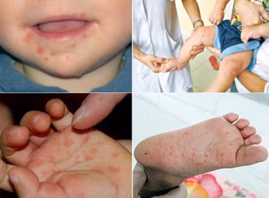Có thể tái nhiễm bệnh tay chân miệng nhiều lần trong năm ảnh 1