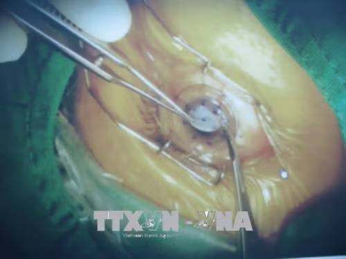 Một ca phẫu thuật vừa ghép giác mạc vừa lấy thủy tinh thể và đặt thủy tinh thể nhân tạo cho bệnh nhân (ảnh chụp màn hình). Ảnh: Đinh Hằng – TTXVN
