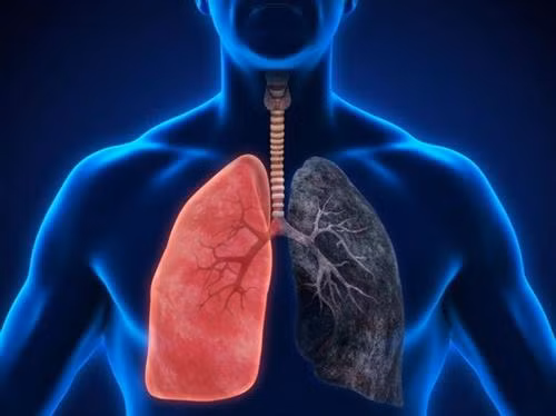 Bệnh nhân nhiễm trùng phổi vốn được coi là bệnh nan y. Ảnh: IVC Northwest