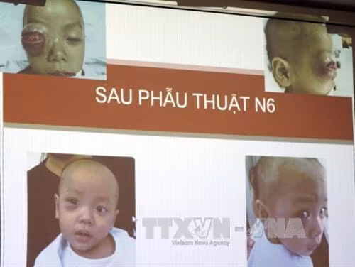 Hình ảnh bé trai 16 tháng tuổi trước và sau khi phẫu thuật biến chứng ổ mắt do viêm xoang. Ảnh: Phương Vy - TTXVN