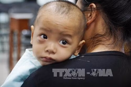 Bé trai sau khi phẫu thuật biến chứng ổ mắt do viêm xoang. Ảnh: Phương Vy - TTXVN