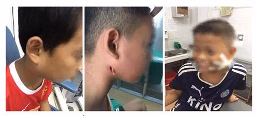 3 trường hợp mắc chứng bệnh Melioidosis (hay còn gọi là Whitmore) điều trị tại Bệnh viện Sản Nhi Nghệ An. Ảnh: 24h.com.vn