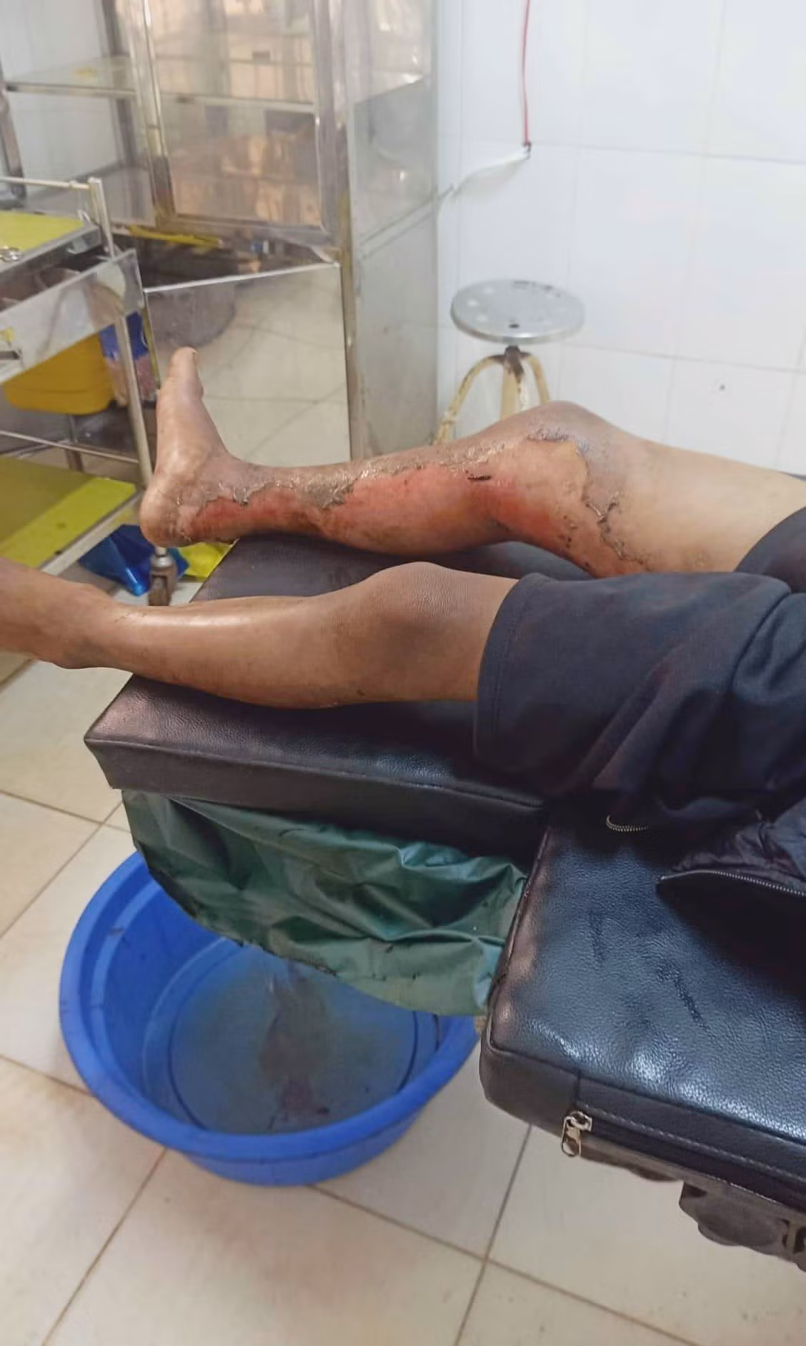 Đắk Lắk: Thông tin thêm về vụ cháu bé 8 tuổi bị bỏng xăng ở huyện Ea H’Leo ảnh 1