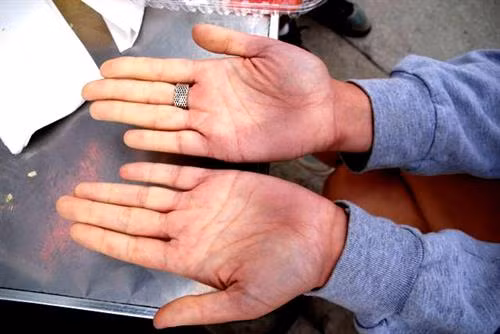 Khi mắc chứng bệnh Raynaud, người bệnh cảm thấy đau đớn, ngứa và tê ở vùng da mất màu, tái lạnh từng mảng, tím, lan nhanh ở cả hai bàn tay và chân.