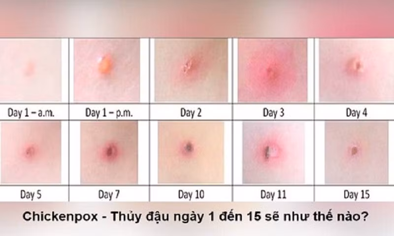 Hà Tĩnh cơ bản khống chế được ổ dịch thủy đậu ở xã Việt Tiến, huyện Thạch Hà ảnh 1