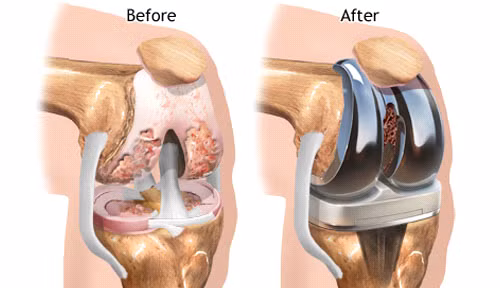 Trung Quốc phát triển sụn khớp nhân tạo có tính ứng dụng cao ảnh 1