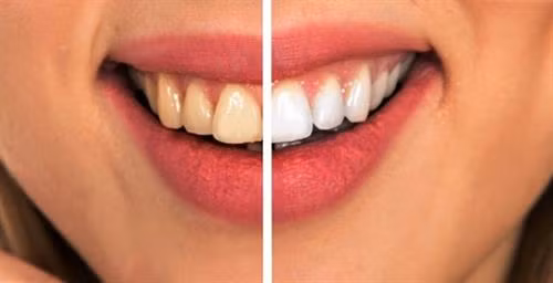 Những cách đơn giản ngừa sâu răng không cần dùng thuốc ảnh 5