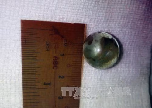 Viên bi được lấy ra trong mắt cho bệnh nhi Y Khương Mlo. Ảnh: Phương Vy-TTXVN.