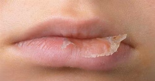 Môi dễ bị khô nẻ khi trời khô hanh