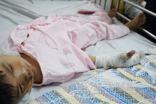 Bệnh nhi Trần Tiến Phước (5 tuổi, quê Kiên Giang) với các vết thương. Ảnh: Phương Vy-TTXVN.