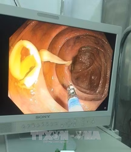 Kéo con sán xơ mít dài 1,2 mét ra khỏi bụng một bệnh nhân ảnh 1