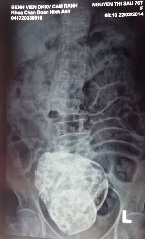 Thai nhi hóa đá trong bụng cụ bà 76 tuổi ảnh 1