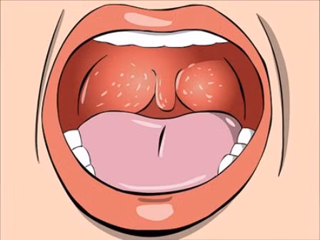 Phát triển phương pháp mới chẩn đoán sớm ung thư vòm họng ảnh 1