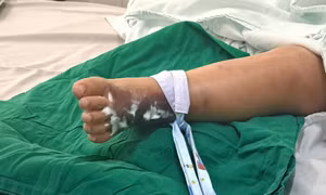 Bị rắn hổ mèo cắn, bé trai sốc nhiễm trùng, nhiễm độc toàn thân