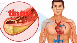 "Bác sĩ ơi' - Kiểm soát Cholesterol máu thế nào là đúng?
