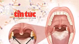 Bác sĩ ơi: Bác sĩ chỉ ra những dấu hiệu nhận biết bệnh bạch hầu