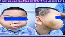 Phẫu thuật thành công ca u xơ vòm họng hiếm gặp ở bệnh nhi
