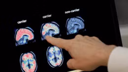 Loại thuốc đầu tiên có thể làm chậm bệnh Alzheimer