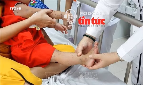 Cảnh giác chủng EV71 gây bệnh tay chân miệng biến chứng nặng