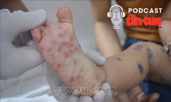 Bác sĩ ơi: Dấu hiệu nhận biết sớm bệnh tay chân miệng