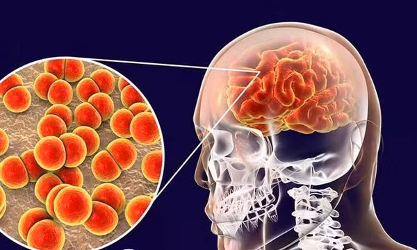 Bác sĩ ơi: Bệnh viêm não do mô cầu nguy hiểm thế nào với trẻ em?