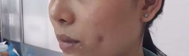  Mũi, mắt, má bị nhiễm trùng nặng vì làm đẹp tại... tiệm làm tóc ảnh 2