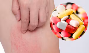 Bác sĩ khuyến cáo cẩn trọng với dị ứng thuốc gây biến chứng nguy hiểm