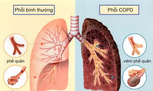 Chủ nhiệm Chương trình chống Lao Quốc gia: Chống Lao phải như phòng, chống COVID-19