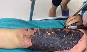 Nhiễm trùng nặng do tự đắp thuốc lá chữa bỏng