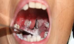 Quảng Trị thêm 9 trường hợp mắc bệnh bạch hầu trong cộng đồng