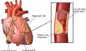 Báo động tình trạng thừa cholesterol gây các bệnh lý về tim mạch