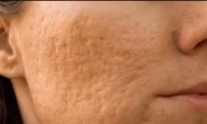 Sống lành mạnh giúp giảm tình trạng da sần vỏ cam phổ biến ở phụ nữ trung niên