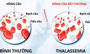  Phòng, chống bệnh tan máu bẩm sinh ở vùng đồng bào dân tộc thiểu số, miền núi