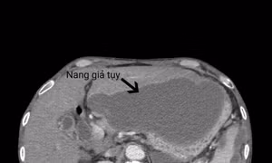 Điều trị sỏi đường mật và nang giả tụy không cần phẫu thuật