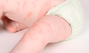 Nghiên cứu mới về ảnh hưởng do dị ứng thực phẩm ở trẻ sơ sinh