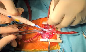Nghiên cứu mới giúp điều trị rối loạn nhịp tim