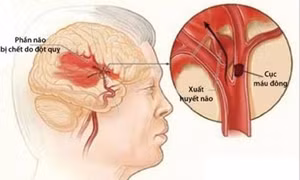 Cục máu đông gây đột quỵ não. Ảnh: benhvien108.vn