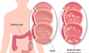 Liệu pháp mới điều trị hiệu quả bệnh viêm loét đại tràng