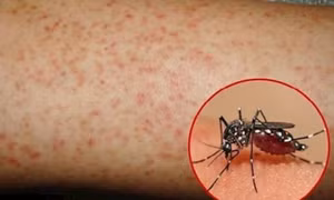 Đắk Lắk ghi nhận một bệnh nhi tử vong vì sốt xuất huyết​