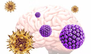 Mối liên hệ giữa bệnh Alzheimer và virus herpes